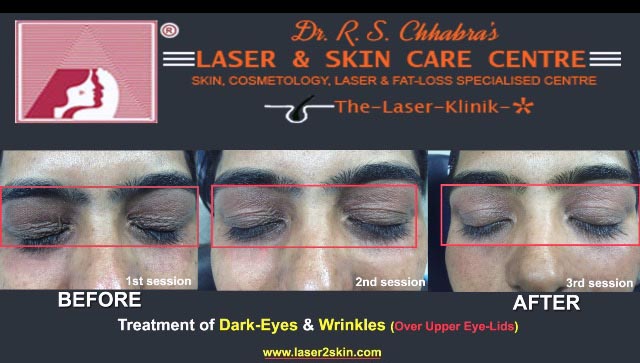 Dark Eye Removal With Q-Switch Laser by Dr R.S. Chhbara