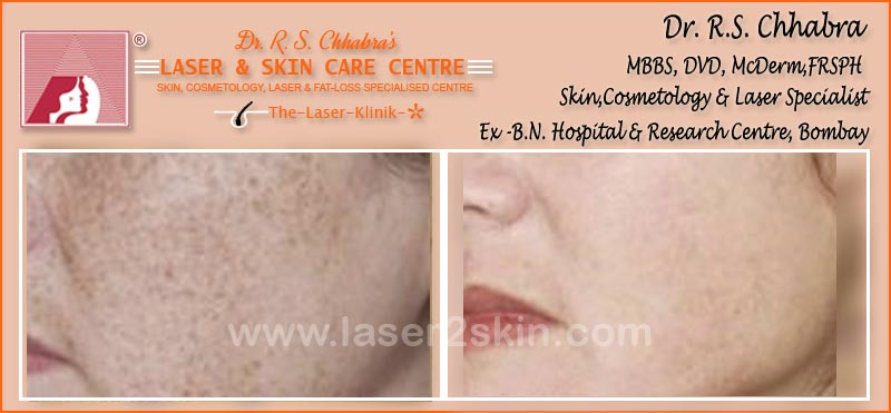 Freckles Removal With Q-Switch Laser by Dr R.S. Chhbara