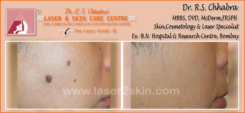 Skin Tags Treatment With Radio-Freq. Cauterisation by Dr R.S. Chhbara