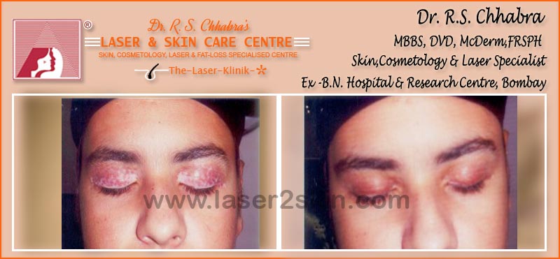 Vitiligo(Leucoderma) Psoriasis With Microphototherapy spot Light Laser by Dr R.S. Chhbara