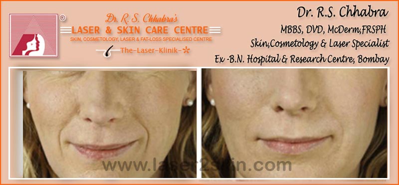 Wrinkles, Crows Feet, Frawn Lines treatment With Botox & Fillers by Dr R.S. Chhbara