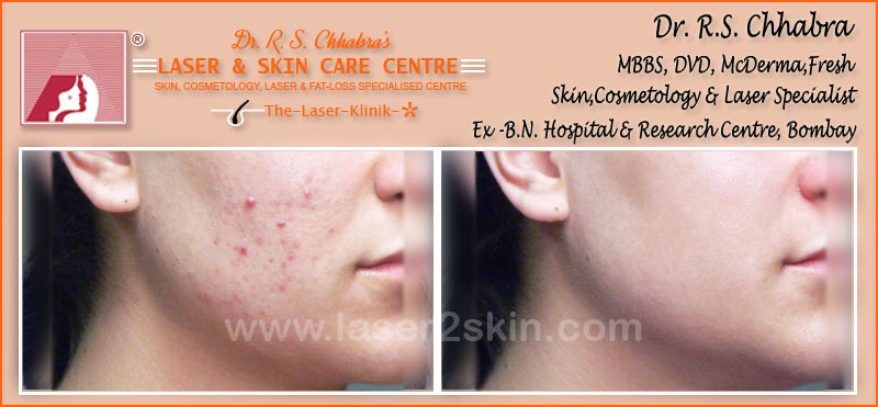 Acne treatment by Dr R.S. Chhbara with IPL & E-Light laser