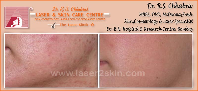 Acne treatment by Dr R.S. Chhbara with IPL & E-Light laser