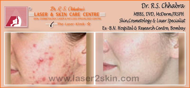 Acne Marks Pores with Microdermabrasion by Dr R.S. Chhbara