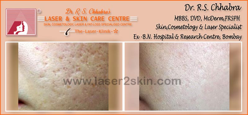 Acne Marks Pores with Microdermabrasion by Dr R.S. Chhbara