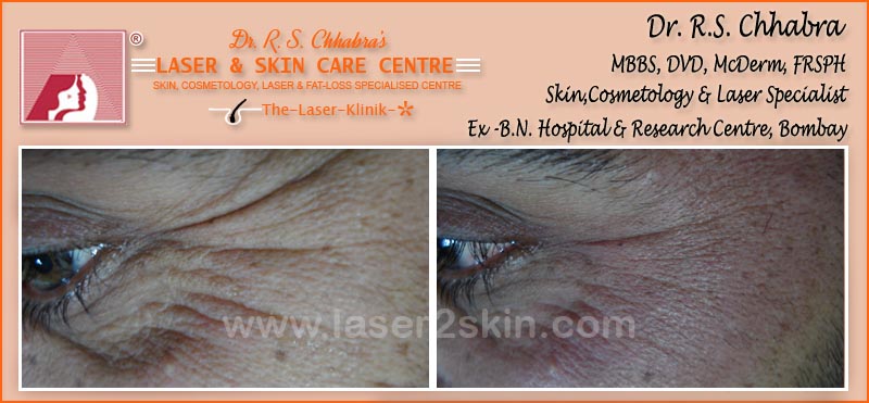 Wrinkles Reduction With Thermo-Cav Lipo Laser Therapy by Dr R.S. Chhbara