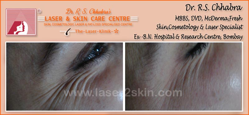 Wrinkles Reduction With Thermo-Cav Lipo Laser Therapy by Dr R.S. Chhbara