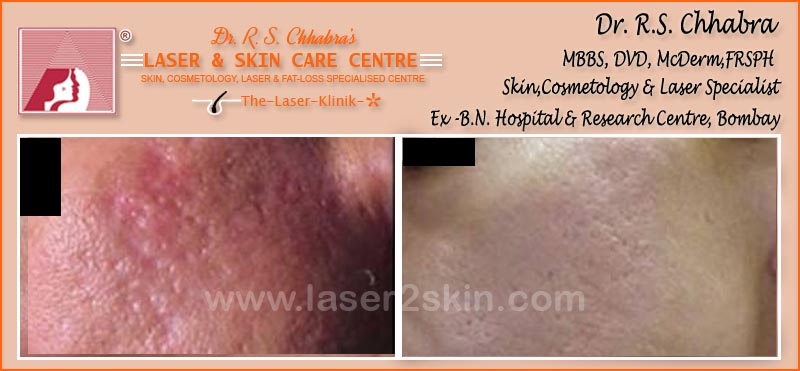 Acne Scars treatment by Dr R.S. Chhbara with IPL & E-Light laser