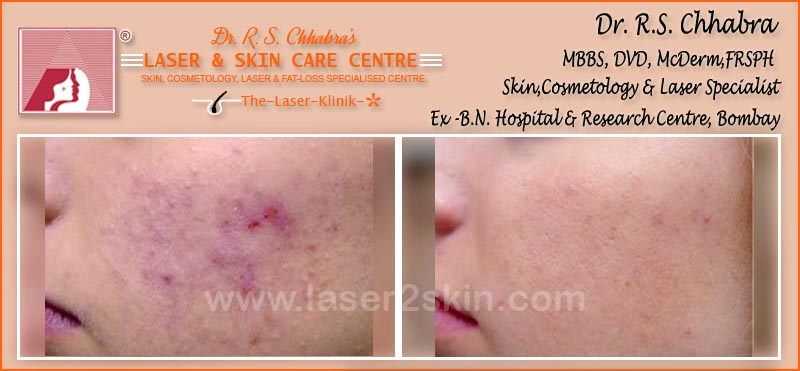 Acne Scars treatment by Dr R.S. Chhbara with laser