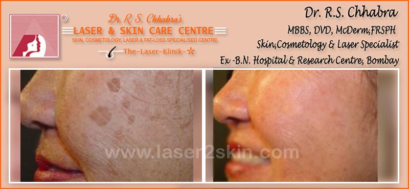 Age & Sun-Spots treatment by Dr R.S. Chhbara with IPL & E-Light laser