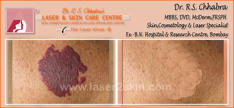 Birth Marks Removal With Q-Switch Laser by Dr R.S. Chhbara