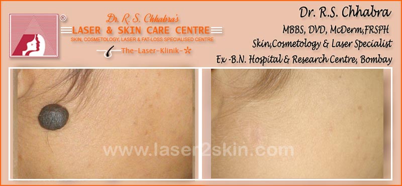 Birth Marks Removal With Q-Switch Laser by Dr R.S. Chhbara