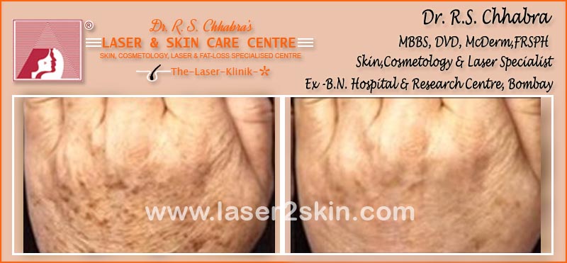 Blemishes Pigmentation With Facial Peeling by Dr R.S. Chhbara
