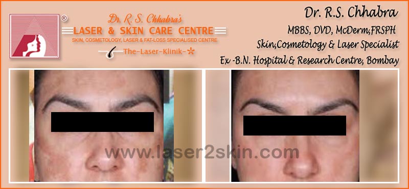 Blemishes Pigmentation With Facial Peeling by Dr R.S. Chhbara