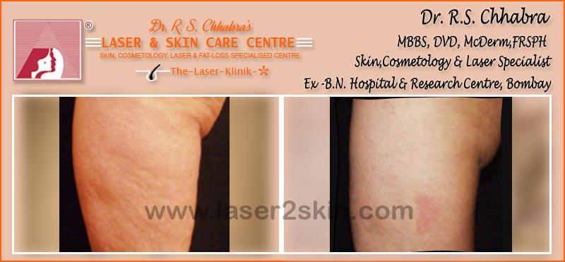 Body Toning With Fat Loss Laser Therapy by Dr R.S. Chhbara
