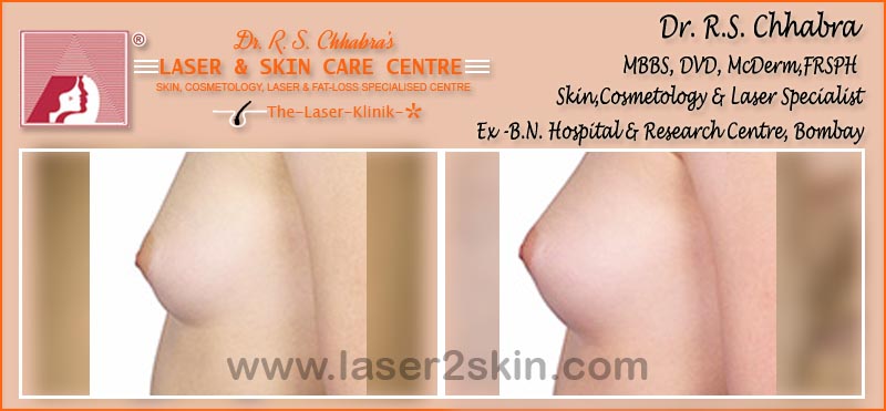 Face & Breast Firming Non-Surgical by Dr R.S. Chhbara