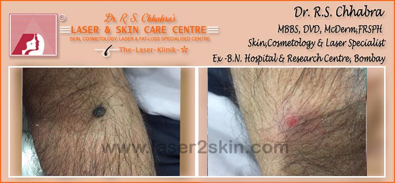 Warts, Moles, Corns, Freckles Treatment With Radio-Freq. Cauterisation by Dr R.S. Chhbara