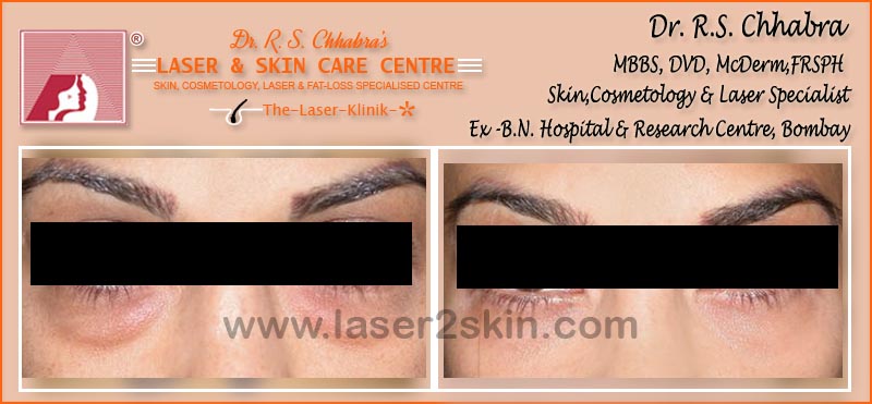 Dark Eye Circles treatment With Ultrasonic & OXY-Therapy by Dr R.S. Chhbara