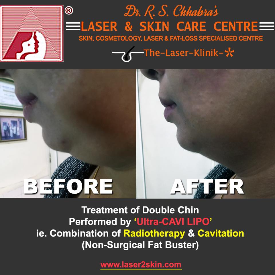 Double Chin Treatment With Thermo-Cav Lipo Laser Therapy by Dr R.S. Chhbara