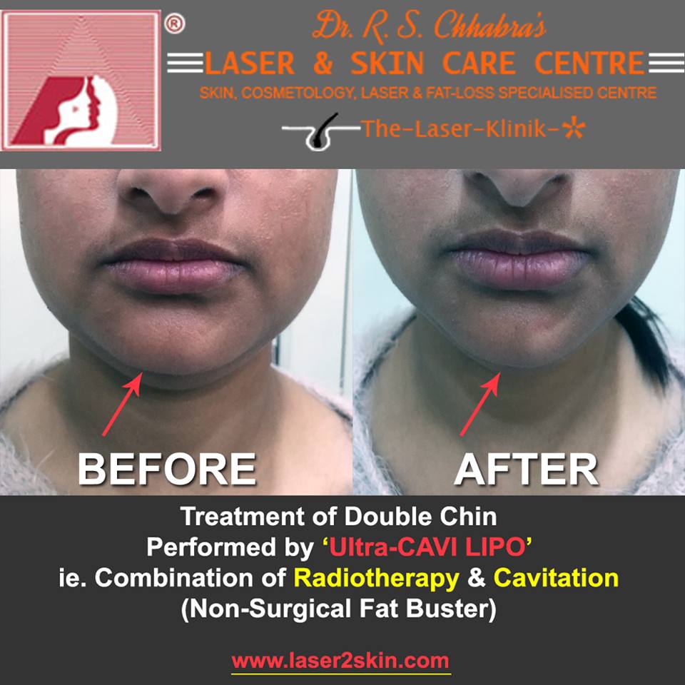 Double Chin Treatment With Thermo-Cav Lipo Laser Therapy by Dr R.S. Chhbara