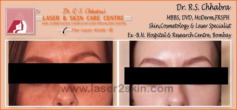 Face & Neck Tanning With Ultrasonic & OXY-Therapy by Dr R.S. Chhbara