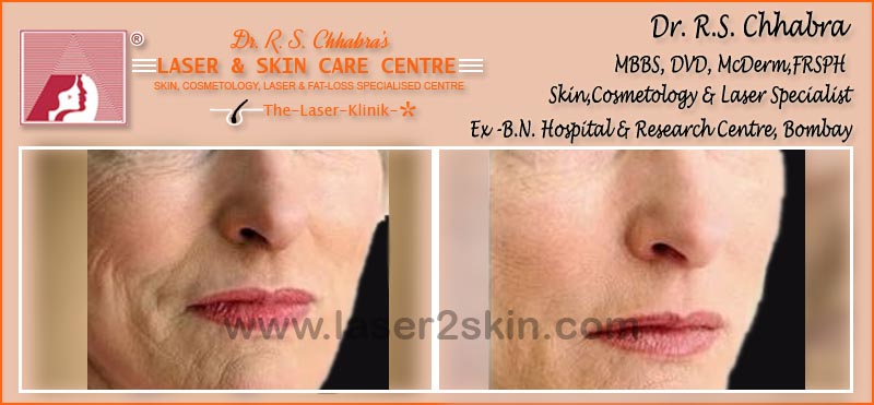 Face Tonning With Thermo-Cav Lipo Laser Therapy by Dr R.S. Chhbara