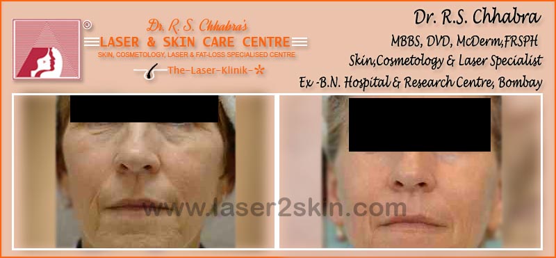 Face Tonning With Thermo-Cav Lipo Laser Therapy by Dr R.S. Chhbara