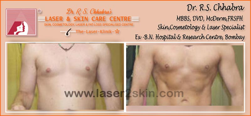 Fat Loss With Fat Loss Laser Therapy by Dr R.S. Chhbara