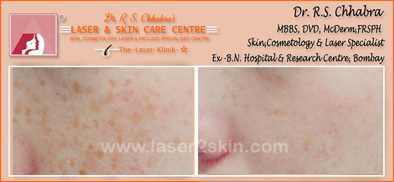 Freckles Removal With Q-Switch Laser by Dr R.S. Chhbara