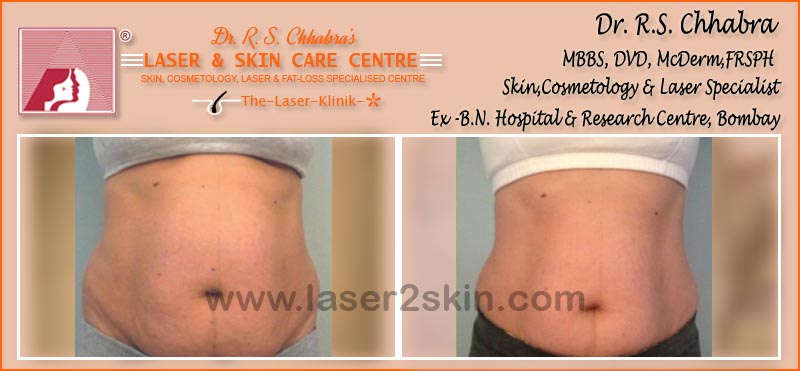 Tummy Reduction With Thermo-Cav Lipo Laser Therapy by Dr R.S. Chhbara