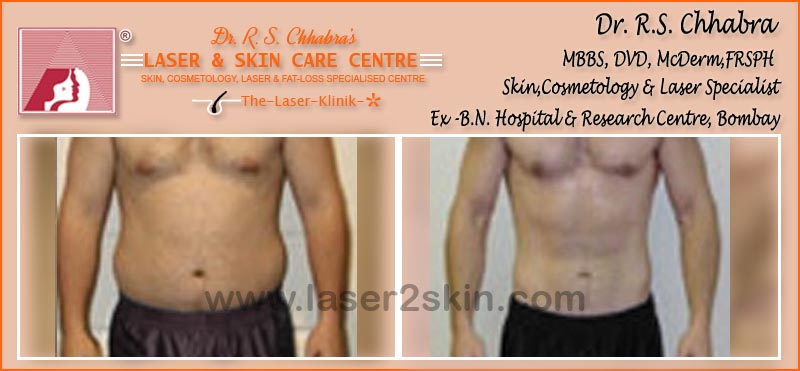 Fat Loss With Fat Loss Laser Therapy by Dr R.S. Chhbara