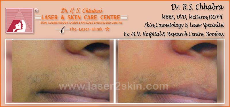 laser hair Removal by Dr R.S. Chhbara