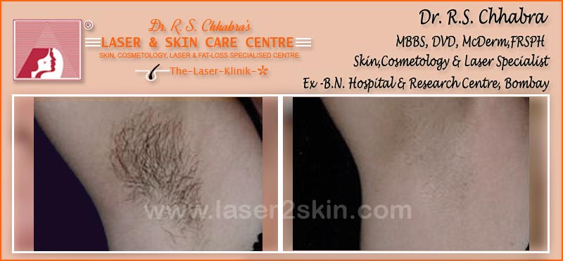laser hair Removal by Dr R.S. Chhbara