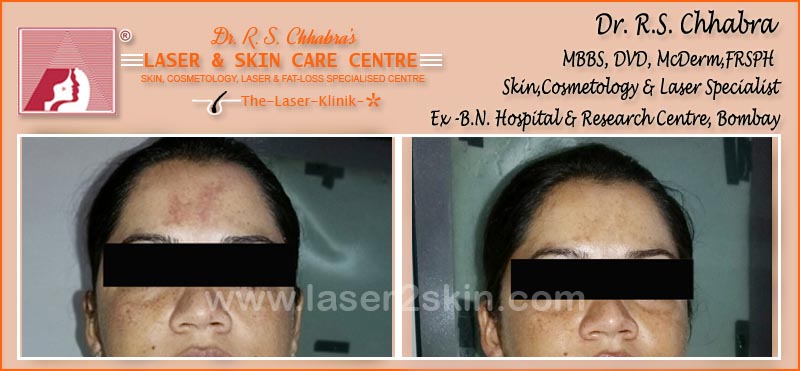 Oxy Derma Therapy by Dr R.S. Chhbara
