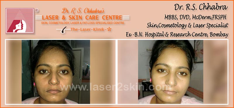 Skin Rejuvenation Instant Glow with Mesotherapy by Dr R.S. Chhbara