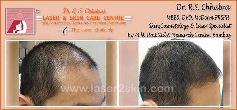PDT Hair Fall Control With PDT Therapy by Dr R.S. Chhbara