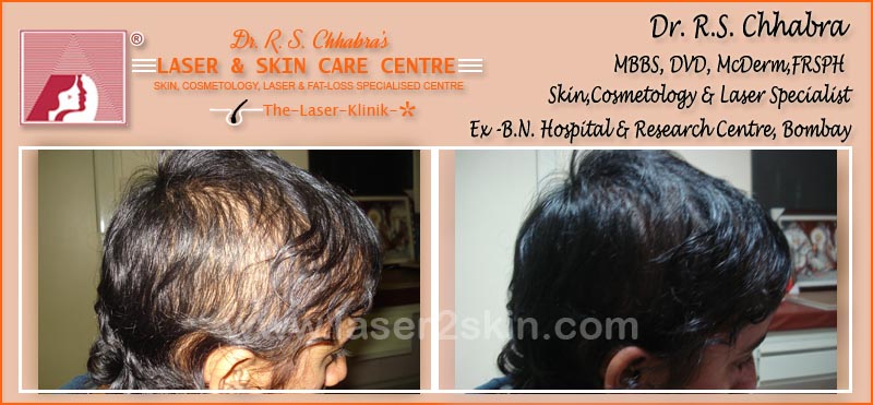 PDT Hair Fall Control With PDT Therapy by Dr R.S. Chhbara
