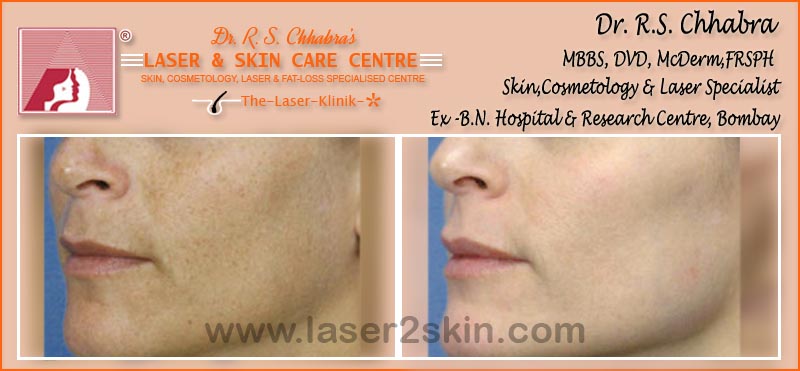 Facial Rejuvenation Instant Glow With Photofacial by Dr R.S. Chhbara