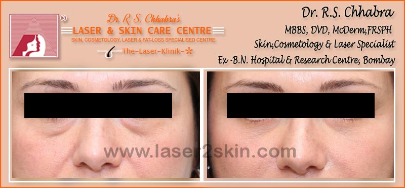 Puffy Eyes treatment With Thermo-Cav Lipo Laser Therapy by Dr R.S. Chhbara