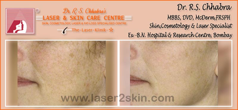 Skin Rejuvenation Instant Glow with Mesotherapy by Dr R.S. Chhbara