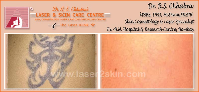 Tattoo Removal With Q-Switch Laser by Dr R.S. Chhbara