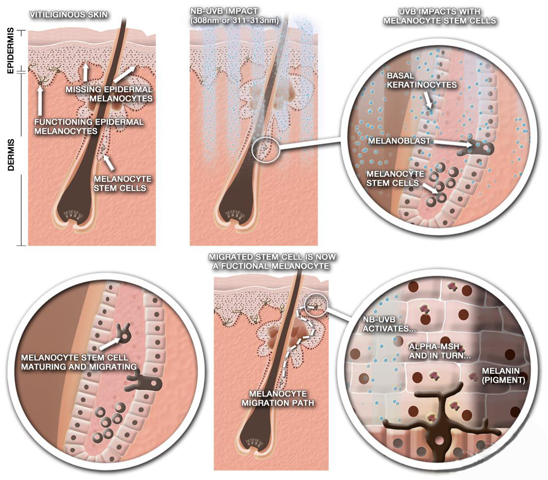 Vitiligo(Leucoderma) Psoriasis With Microphototherapy spot Light Laser by Dr R.S. Chhbara
