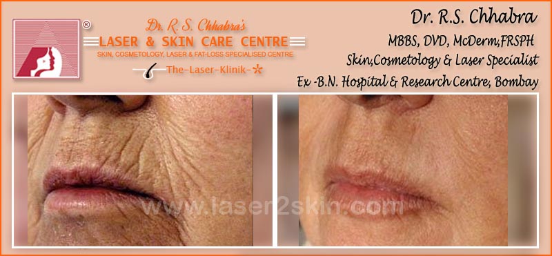 Wrinkles treatment by Dr R.S. Chhbara with IPL & E-Light laser