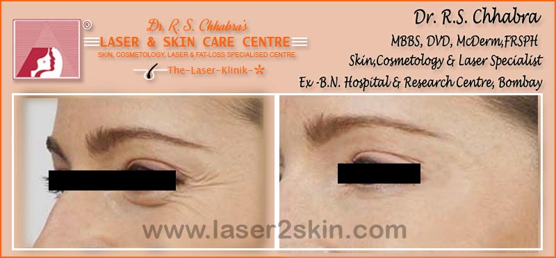 Wrinkles, Crows Feet, Frawn Lines treatment With Fillers by Dr R.S. Chhbara